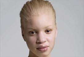 Black skin has 50% lower ceramides than white or hispanic skin. Albino Black Person Kenosha Robinson People With Albinism
