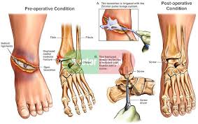 The patellar ligament referred to as the patellar tendon, is the ligament that connects the bottom of the knee cap the acl helps prevent the tibia from sliding forward apart from the rest of the leg. Open Ankle Fracture With Surgical Repairs Doctor Stock Ankle Fracture Ankle Surgery Broken Ankle