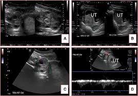 Performance of an ultrasound examination of the female pelvis introduction t he american institute of ultrasound in medicine (aium) is a multidisciplinary association dedicated to advancing the safe and effective use of ultrasound in medicine through professional and public education, research, development Patient 1 34 Year Old Female At 11 3 Weeks Of Gestation After In Download Scientific Diagram