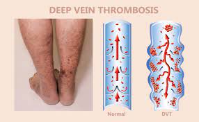 It usually takes three to six months for the clot to completely resolve, but through medical treatment, you can prevent the clot from increasing in size and breaking away. Deep Vein Thrombosis Dvt Vein Specialist Of The Carolinas