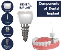 Image result for dental implant