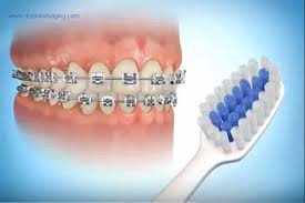 Maybe you would like to learn more about one of these? Caring For Braces Mol Orthodontics
