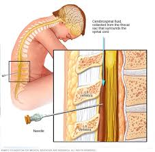 Multiple sclerosis (ms) is a chronic autoimmune debilitating disease in which nerve damage (demyelination of neurons) in the brain and spinal cord disrupts their communication with the body. Multiple Sclerosis Diagnosis And Treatment Mayo Clinic