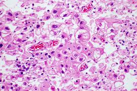 Studies also show they reduce the side effects of chemotherapy or radiation treatment. Deworming Pill May Be Effective In Treating Liver Cancer Uc San Francisco