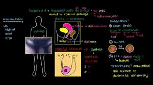 Image result for chancroid