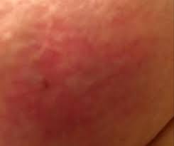 Cancer cells block the lymphatic. Why You Should Never Ignore A Red Patch On Your Chest Newbeauty