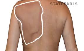 Image result for Winged Scapula
