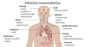 Check spelling or type a new query. Infekcna Mononukleoza