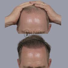 Image result for Tinea Capitis