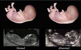 What does nt measurement mean? Nipt Screening Nuchal Translucency Complimentary Rather Than Alternatives