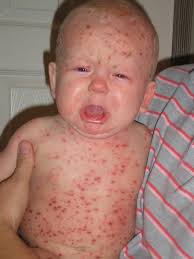 Image result for shingles in children