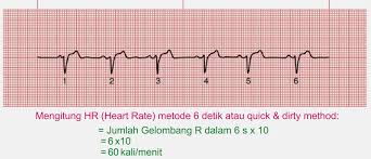 Interpretasi Ekg 5 Langkah