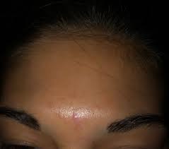 Because malassezia is normally present on our skin, dr. Tender Bumps Fungal Acne Beauty Insider Community