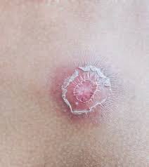 Image result for Skin Abscess