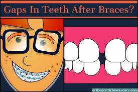 There are a variety of factors to consider when answering this question. Gaps In Teeth After Braces Is It Normal How To Fix It Orthodontic Braces Care
