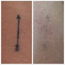 Laser tattoo removal in brisbane, gold coast, melbourne and perth. Laser Tattoo Removal Gold Coast Oo La La Cosmetic Laser Clinic Surfers Paradse