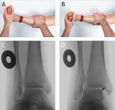 Image result for Ankle External Rotation Test