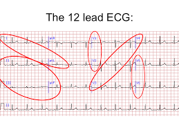 12 Lead Ecg Interpretation Lesson And Practice Quiz 311