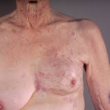 Of course, your specialist is the main person whose advice you should follow but it doesn't do anyone harm. Pdf Response Of Cutaneous Metastases From Breast Cancer To Capecitabine