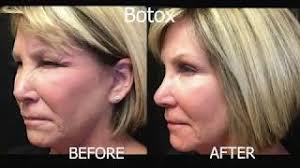 Dysport for Men in Reno, Sparks & Hidden Valley, NV Reno NV