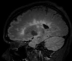 التصلب المتعدد (ms) هو مرض من المحتمل أن يُعيق الدماغ والحبل النخاعي (الجهاز العصبي المركزي). Ø§Ù„ØªØµÙ„Ø¨ Ø§Ù„Ù„ÙˆÙŠØ­ÙŠ Multiple Sclerosis