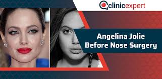 Angelina jolie's recent breast reconstruction opened up a discussion on surgical options. Angelina Jolie Before Nose Surgery Clinicexpert Aesthetics