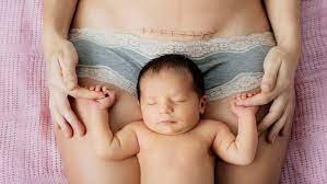 10 Common Questions About C Section Scars