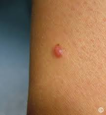 Image result for Spitz Nevus