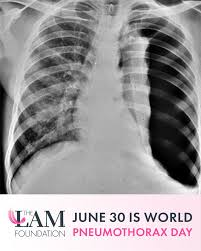 Image result for Pneumothorax