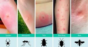 Bug Bite Black And Blue Ring How To Recognize Various Bug Bites Coolguides