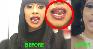 cardi B teeth before