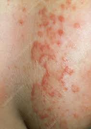 Image result for Intertrigo under breasts