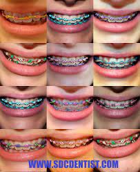 From candy apple red to deep maroon, royal blue or a pretty shade of teal, you have more choices than ever when it comes to colored braces. Pin By Silvia Simara On Dentalterest Braces Colors Cute Braces Braces Dentist