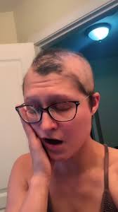 Bald Girl with Trichotillomania Gets Tattoo