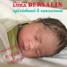 Risau kalau luka lambat sembuh & luka terbuka akan dijahit kali kedua? Cerita Jenis Luka Bersalin Episiotomi Caesarean Bubblynotes Malaysia Parenting Lifestyle Blog
