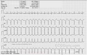 Atrial Fibrillation Ecg Guru Instructor Resources