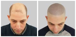 Homebokep indobokep indo abg smp terbaru 2020. Scalp Micropigmentation Leading Experts Scalp Culture