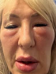 The TGA has issued 2 infringement notices totalling $7,716 to a  Queensland-based individual for the alleged unlawful importation of  counterfeit botulinum toxin type A and the unlawful advertising of cosmetic  injectables in