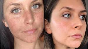 To keep one's skin fresh, various anti aging treatments in dubai are available. The Exact Anti Aging Products That Helped Heal Years Of Sun Damage On This Woman S Face Sun Damaged Skin Skin Treatments Damaged Skin