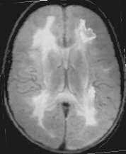 Leukenzephalopathie