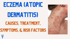 Image result for Atopic eczema atopic dermatitis