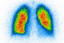 Da man ein szintigramm mithilfe von schwach radioaktiven substanzen erstellt, ist die szintigraphie eine nuklearmedizinische untersuchung. Szintigraphie Der Lunge Im Radiologiezentrum Rastatt