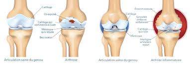 Le genou est une articulation très sollicitée dans notre vie quotidienne, en cas de douleur on parle de ce fait, le faible emboitement des surfaces articulaires expose au douleur du genou en marchant. Comprendre Nos Articulations Societe De L Arthrite
