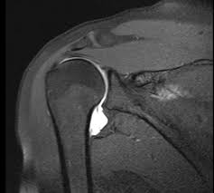 A great use of hagl is when writing in someone's yearbook who you don't plan on seeing over the upcoming summer, or ever again for that matter. Humeral Avulsion Glenohumeral Ligament Hagl Shoulder Elbow Orthobullets