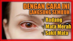Disusun bersama theodore leng, md. Cara Mengobati Sakit Mata Merah Dan Bengkak Secara Alami Dalam Sekejap Youtube