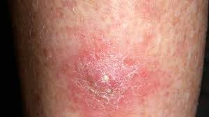 Actinic keratoses are very common, and many people have them. Skin Cancer Symptoms Pictures Types And More