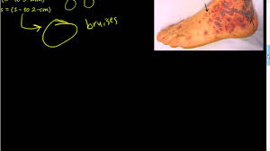 The bleeding results from unusually low levels of platelets — the cells that help blood clot. 47 Hemorrhage Petechiae Purpura Ecchymoses Youtube