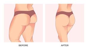 Brazilian Butt Lift Recovery Tips and ...
