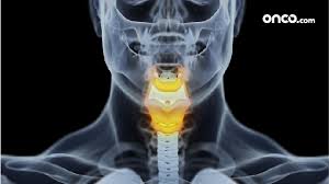 How does a colon cancer look like? Stage 2 Throat Cancer Early Localized Throat Cancer Onco Com