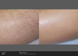 Here are pictures, removal procedure, treatment for infected cysts and how to get rid of ingrown hair follicle cysts naturally. Laser Hair Removal Ipl Hair Removal Radiance Skincare Laser Medspa Wheaton Il